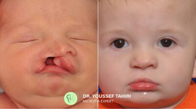 Before & After result