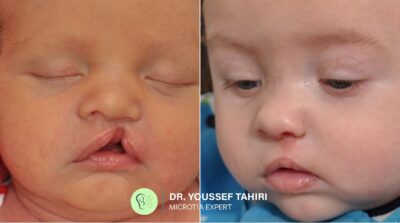 Before & After result