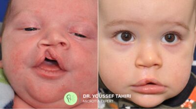 Before & After result