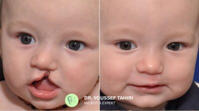 Before & After result