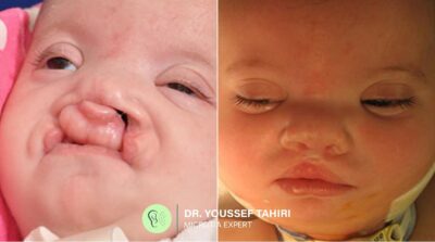 Before & After result