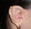 Early exposure or impeding exposure of SUPOR™ implant in Microtia Reconstruction