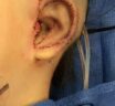 What a SUPOR™ ear reconstruction looks like in the operating table at the end of surgery?