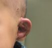 SUPOR™ ear reconstruction – what it looks like at 2 weeks post-operatively