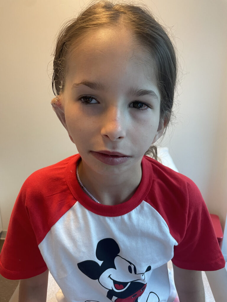 Young girl showing facial asymmetry associated with hemifacial microsomia