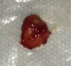 Dermoid cyst excision