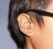SUPOR™ Implant Fracture in Microtia Reconstruction