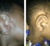 Salvage ear reconstruction after an infection and exposure