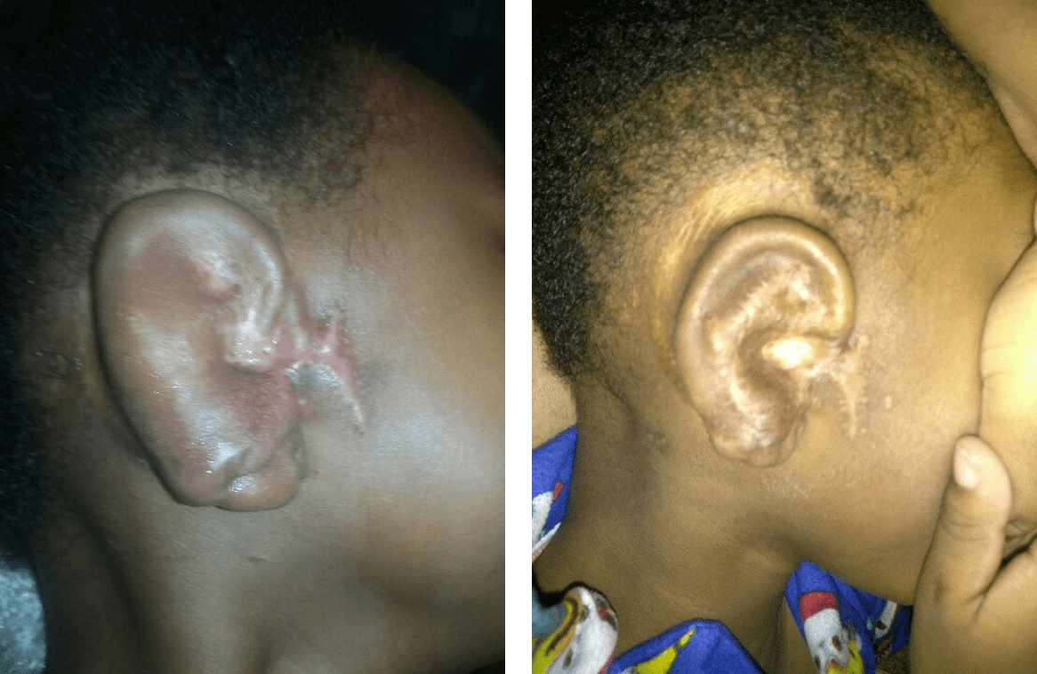 Salvage ear reconstruction after an infection and exposure