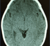 Why do we operate on Craniosynostosis?