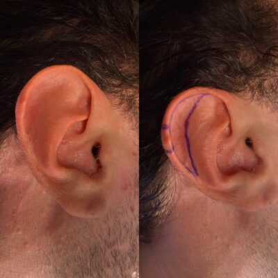 Ear reduction surgery before and after — Dr. Youssef Tahiri