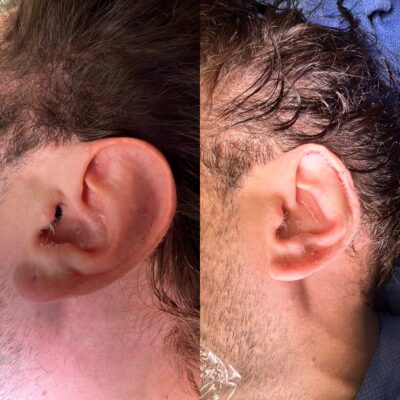 Ear reduction surgery before and after — Dr. Youssef Tahiri