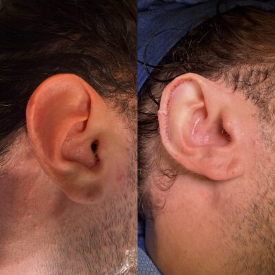 Ear reduction surgery before and after — Dr. Youssef Tahiri