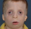 Can Treacher Collins Syndrome Affect Your Child’s Life Expectancy? It Doesn’t Have To