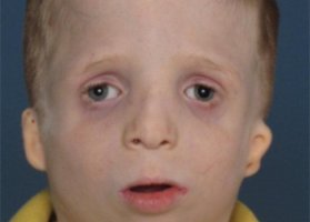 Can Treacher Collins Syndrome Affect Your Child’s Life Expectancy? It Doesn’t Have To