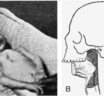 Do all Pierre Robin Sequence patients have Cleft Palate? A little history on Pierre Robin Sequence