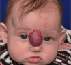 Hemangioma vs. Vascular malformation, that is the question!