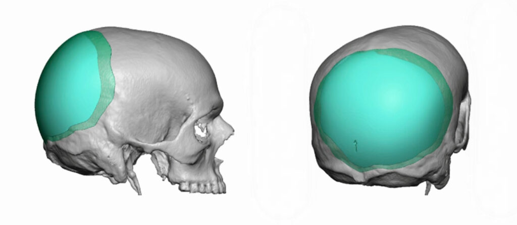 3D medical rendering of a skull showing the cranioplasty implant area highlighted in teal, from side and rear views