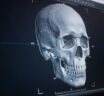 Typical response to a Augmentation Cranioplasty Inquiry