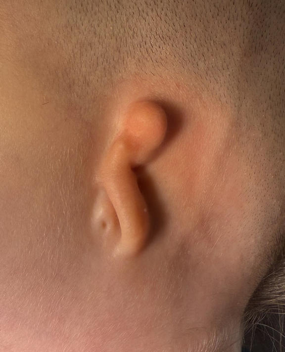 Microtia
