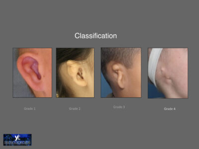 Classification chart showing four grades of microtia with example ear photos for each grade