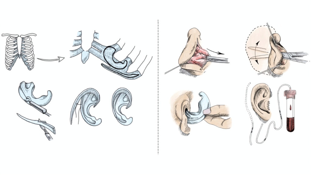 The Cartilage Technique