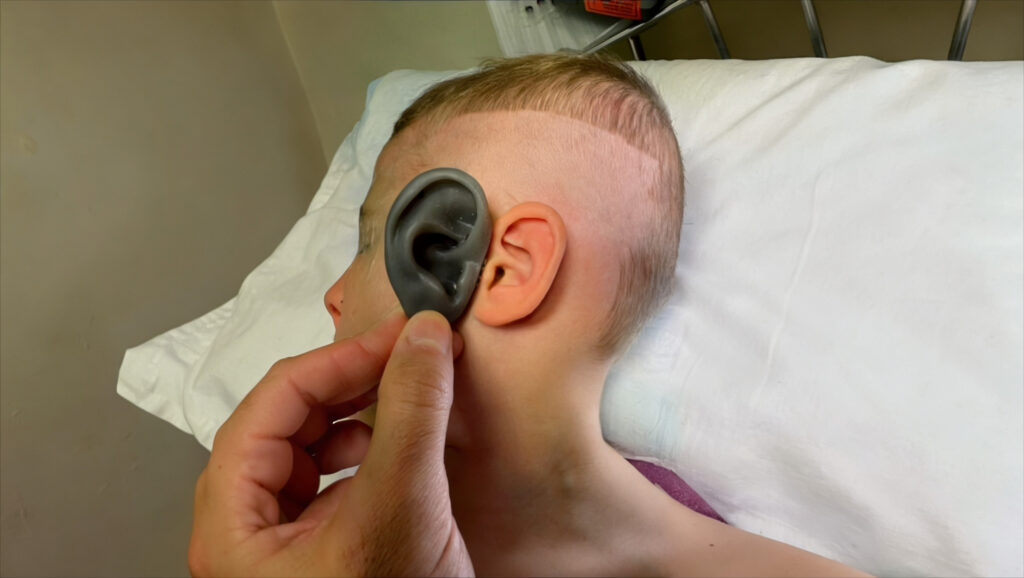 SUPOR ear framework implant held against a child's head for reference