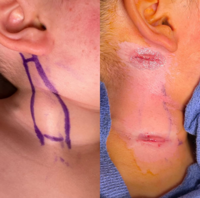 Side-by-side photos showing surgical markings for torticollis release and the healing incision afterward
