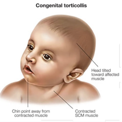 Medical illustration of congenital torticollis showing head tilt, chin position, and the contracted neck muscle